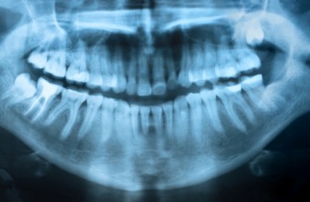 Should Wisdom Teeth Be Removed?