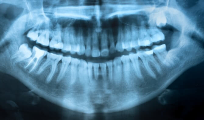 Should Wisdom Teeth Be Removed?