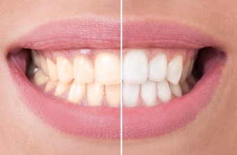 7 Misconceptions About Teeth Whitening