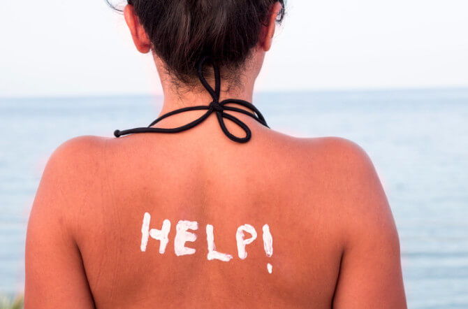 Sunburned - What to Do, When to Seek Help